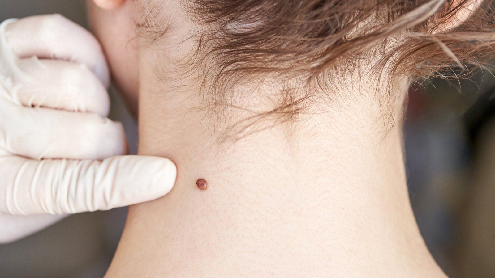 Examen rapproché d'un grain de beauté sur la peau