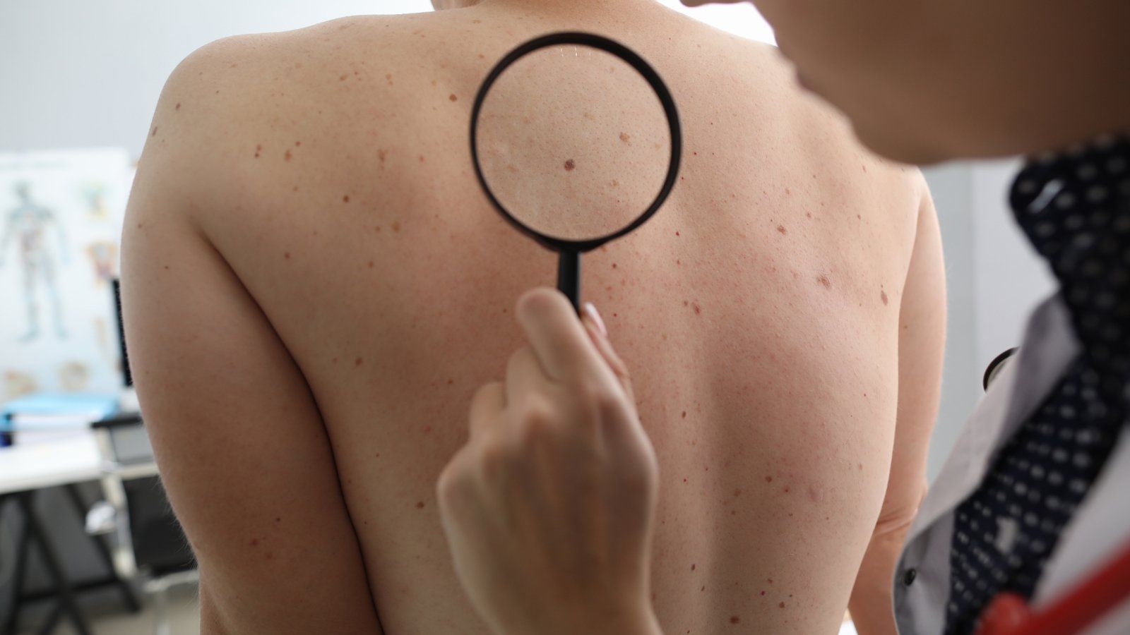Auto-examen des grains de beauté du dos à la loupe